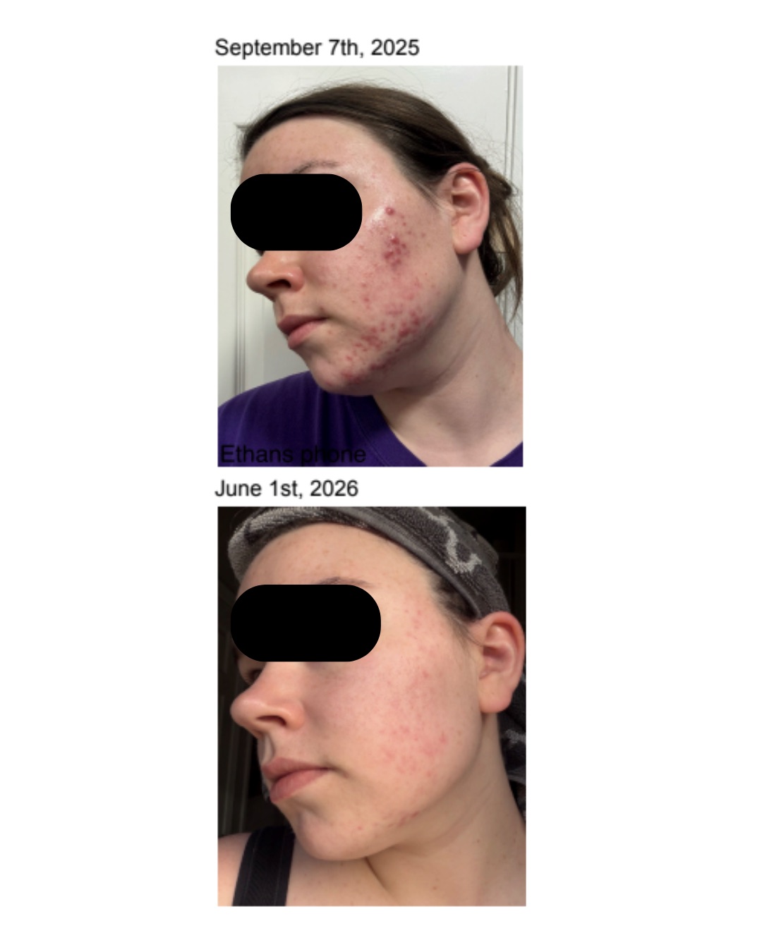 Client before and after — clearer, calmer skin after working with Ella
