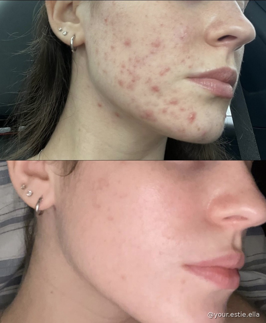 Client before and after — visibly reduced breakouts