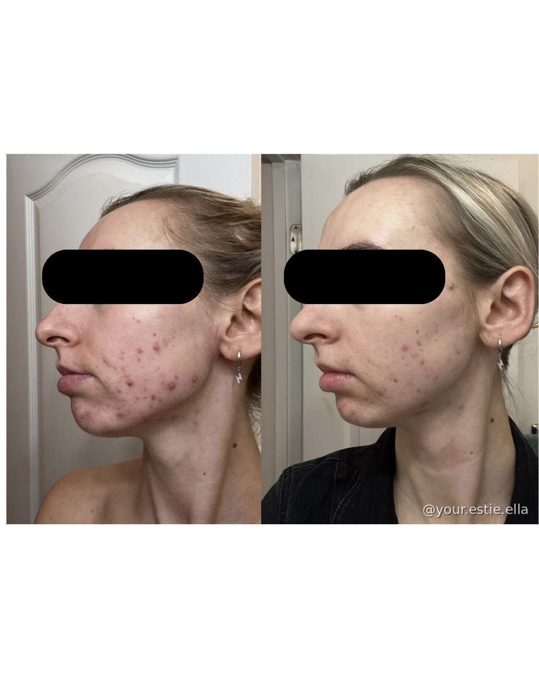 Client before and after — improved tone and texture