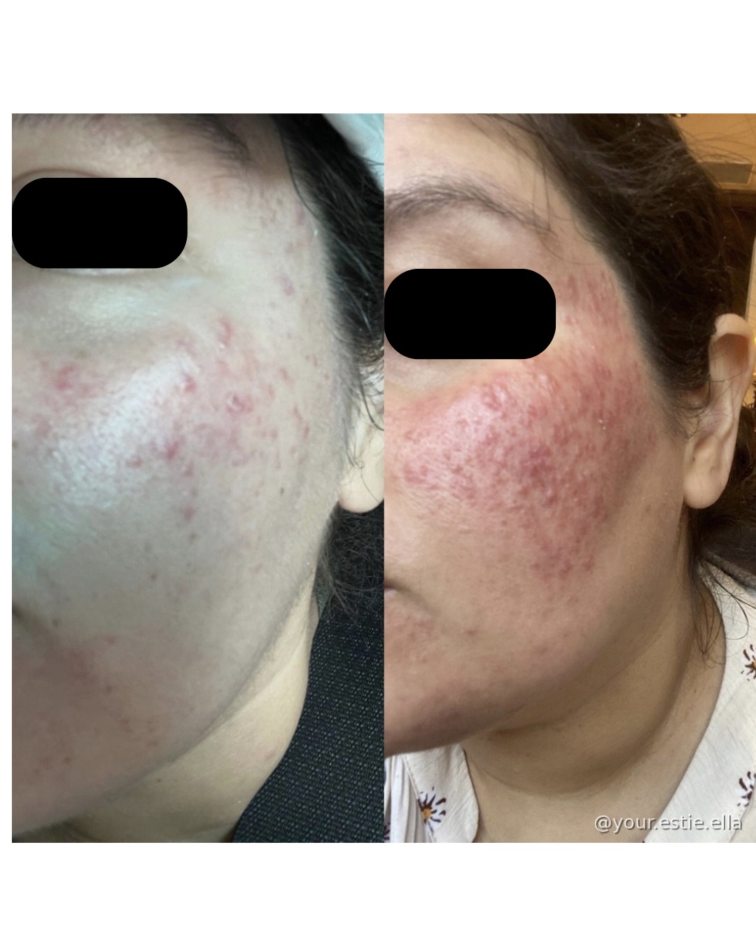 Client before and after — calmer, more even skin